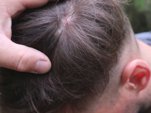 Takový šrám na hlavě si odnesl ze setkání s fantomem jen běžec