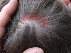 Takový šrám si odnesl ze setkání s fantomem jen běžec