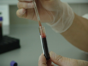 Plzeňané se mohou bezplatně a anonymně testovat na HIV, syfilis a žloutenku