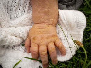 Detail Marečkovi ručičky, na které je patrné onemocnění