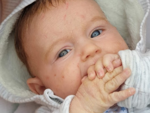 Roční Mareček bojuje se vzácným onemocněním kůže, na které neexistuje lék. Hrozí mu i přehřátí organismu
