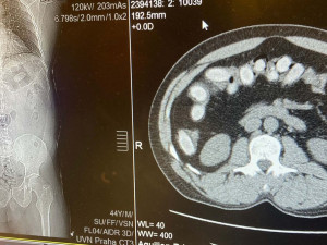 Nigerijský pašerák drog spolykal 55 kapslí s kokainem. Odhalil ho v linkovém autobusu pes celníků