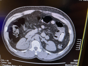 Nigerijský pašerák drog spolykal 55 kapslí s kokainem. Odhalil ho v linkovém autobusu pes celníků
