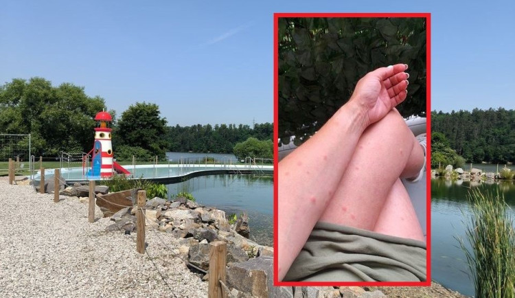 Po návštěvě koupacího jezírka ve Škodalandu se u lidí objevila svědivá vyrážka kůže. Podezření je na ceriakie