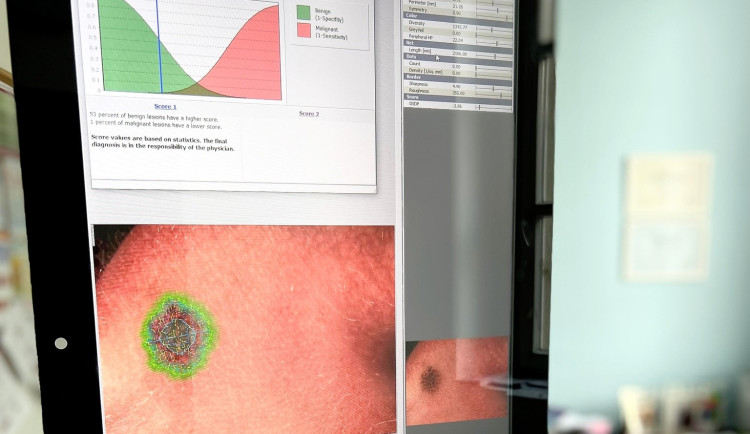 V liberecké nemocnici nabízí možnost vyšetření znamének novou metodou
