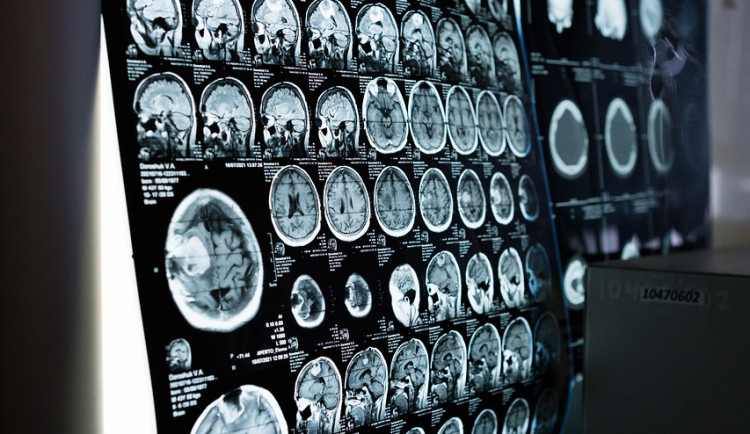 Pacientů s mrtvicemi a demencí přibývá, říká lékař, který ordinuje v nové neurologické ambulanci Rokycanské nemocnice