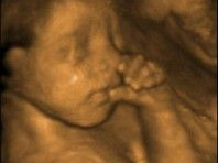 Nemocnice má novou 3D/4D sondu pro prostorové zobrazení plodu při ultrazvukovém vyšetření