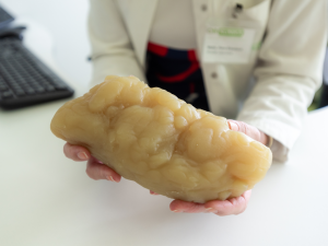 Chcete zhubnout? Léky pomohou, ale samotné nestačí