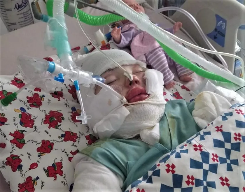 Při nevydařeném chemickém pokusu utrpěla Natálka popáleniny na 43 procentech těla, její utrpení nebere konce