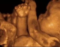 Nemocnice má novou 3D/4D sondu pro prostorové zobrazení plodu při ultrazvukovém vyšetření