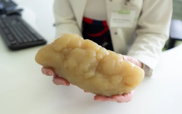 Chcete zhubnout? Léky pomohou, ale samotné nestačí