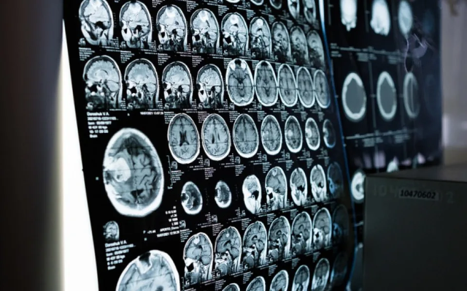 Pacientů s mrtvicemi a demencí přibývá, říká lékař, který ordinuje v nové neurologické ambulanci Rokycanské nemocnice